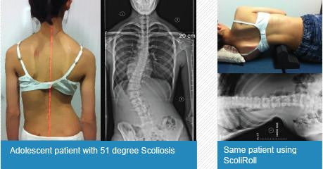 ScoliRoll Lumbar
